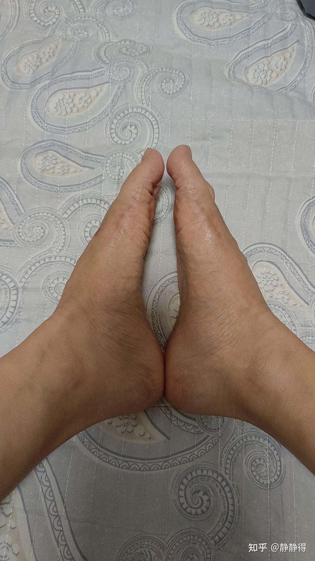JJJ正式接受脚趾手术三个月后重新评估的简单介绍